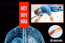 Nhận biết sớm thể đột quỵ não tránh biến chứng nguy hiểm