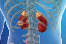 Dấu hiệu cảnh báo ung thư thận