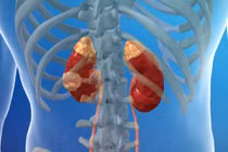 Dấu hiệu cảnh báo ung thư thận