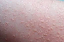 Cách phòng ngừa mày đay bùng phát khi trời lạnh