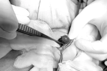 Bé trai 2 tuổi phải cắt bỏ tinh hoàn vì xoắn tinh hoàn