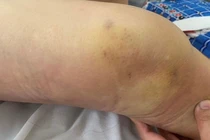 Nhiều người cứng khớp, teo cơ vì tiêm khớp không an toàn