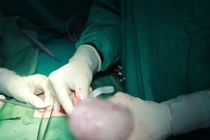 Nữ sinh 17 tuổi bị u nang buồng trứng nguy cơ ác tính cao