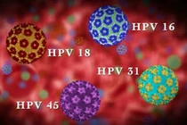 Bác sĩ chỉ rõ dương tính HPV có phải mắc ung thư cổ tử cung?