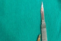 Xương gà trú ngụ nhiều năm đâm thủng trực tràng