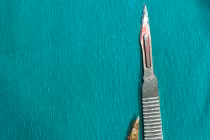 Xương gà trú ngụ nhiều năm đâm thủng trực tràng