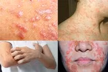 Cách phòng bệnh da liễu khi thời tiết thay đổi