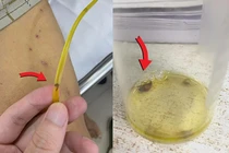 Hy hữu: sán lá gan chui ra từ ống dẫn lưu đường mật