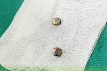 Gắp dị vật trong âm đạo bé 5 tuổi