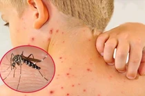 Hơn 87.000 ca sốt xuất huyết, 24 trường hợp tử vong