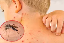 Hơn 87.000 ca sốt xuất huyết, 24 trường hợp tử vong