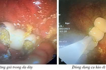Hy hữu: 4 răng giả rơi vào dạ dày
