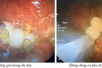 Hy hữu: 4 răng giả rơi vào dạ dày