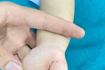 Bé trai 18 tháng tuổi bị chó cắn vỡ lún xương sọ