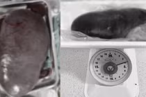 Hy hữu: Lách khổng lồ nặng 4kg chiếm hơn nửa ổ bụng quý ông 61 tuổi