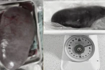 Hy hữu: Lách khổng lồ nặng 4kg chiếm hơn nửa ổ bụng quý ông 61 tuổi