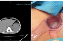 Bé 8 tuổi thủng trực tràng do bạn trêu ngồi vào chiếc bút dựng ngược