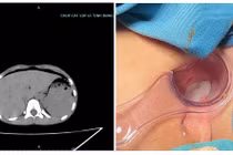 Bé 8 tuổi thủng trực tràng do bạn trêu ngồi vào chiếc bút dựng ngược