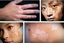 Chế độ ăn bổ sung có bằng chứng trong bệnh bạch biến