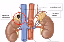 Tưởng tăng huyết áp thông thường nào ngờ u tuyến thượng thận ác tính