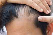 Rụng tóc từng mảng