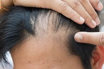 Rụng tóc từng mảng