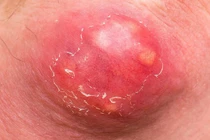 Cách xử lý mụn nhọt, tránh nhiễm trùng nguy hiểm