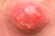 Cách xử lý mụn nhọt, tránh nhiễm trùng nguy hiểm