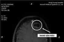 Thích ăn tiết canh, liên tiếp hai bệnh nhân bị nang sán trong não