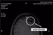 Thích ăn tiết canh, liên tiếp hai bệnh nhân bị nang sán trong não