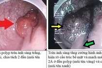 Hy hữu: Polyp đại trực tràng cũng có đôi
