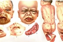 Sàng lọc giang mai khi mang thai tránh bệnh lý nguy hiểm cho con