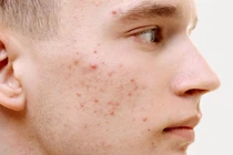 Bác sĩ da liễu chỉ rõ nguyên tắc trị mụn trứng cá hiệu quả