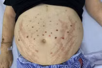 Phù và nhiễm trùng nặng do dùng ong châm chữa bệnh