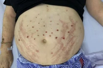 Phù và nhiễm trùng nặng do dùng ong châm chữa bệnh