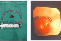 Hạt hồng xiêm trú trong phế quản 10 ngày