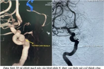 Đau đầu đi khám cô gái trẻ phát hiện “quả bom” nổ chậm trong não