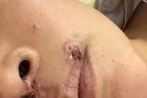 Hai người sốc, viêm phổi và hôn mê do ăn tiết canh lợn