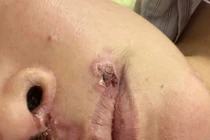 Hai người sốc, viêm phổi và hôn mê do ăn tiết canh lợn