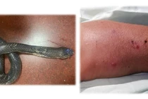 Truyền 70 lọ huyết thanh “cứu” liên tiếp 03 bệnh nhân bị rắn cắn tại nhà