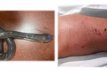 Truyền 70 lọ huyết thanh “cứu” liên tiếp 03 bệnh nhân bị rắn cắn tại nhà