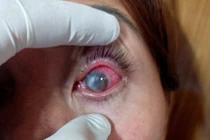 Tự mua thuốc trị đau mắt đỏ, bệnh nhân bị loét giác mạc, mủ tiền phòng