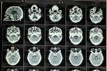 Cứu bệnh nhân đái tháo đường xuất huyết não vì cơn tăng huyết áp cấp cứu