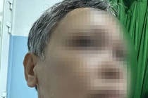 Bị bướu cổ 30 năm không mổ, u khổng lồ chèn ép khí quản