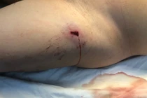 Lấy đạn xuyên thấu bụng, thủng gan và đùi cho chiến sĩ công an