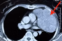 Mổ ruột thừa phát hiện u trung thất lớn đẩy xẹp phổi