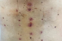 Da tấy đỏ, lở loét vì chữa đau lưng ở “thầy lang”