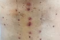 Da tấy đỏ, lở loét vì chữa đau lưng ở “thầy lang”