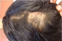 Bác sĩ chỉ rõ bệnh nấm da đầu gây nổi hạch và rụng tóc vĩnh viễn