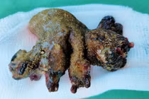 Khối sỏi lớn trong thận của người bệnh